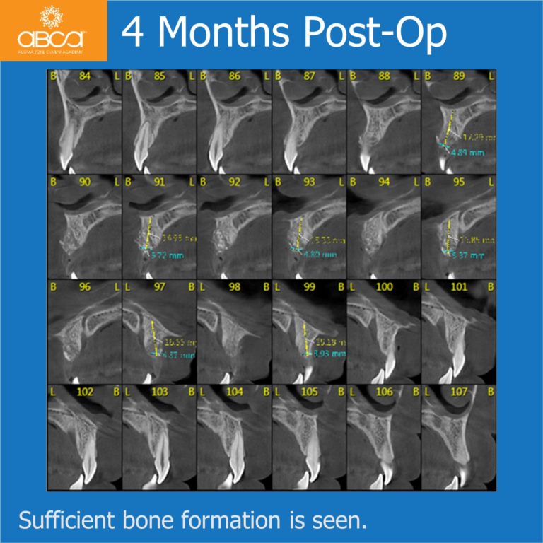 Implant and Augma in the Aesthetic Zone